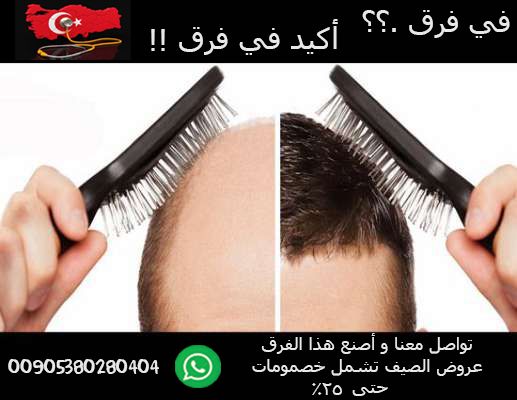 زراعة الشعر في تركيا  اسطنبول