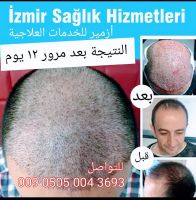 زراعة الشعر في تركيا 