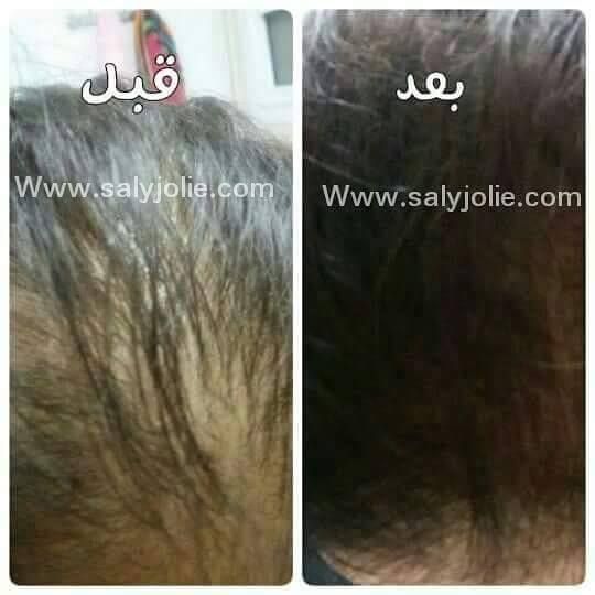 علاج تساقط شعر في مصر