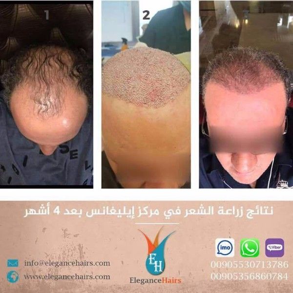 زراعة الشعر وعلاج التساقط