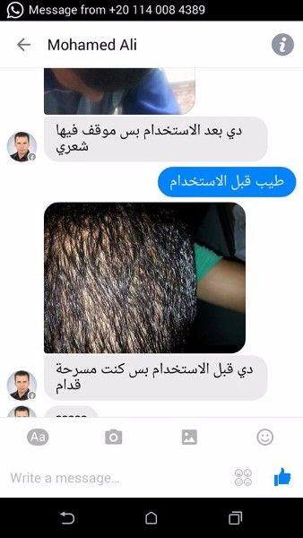 علاج تساقط شعر في مصر